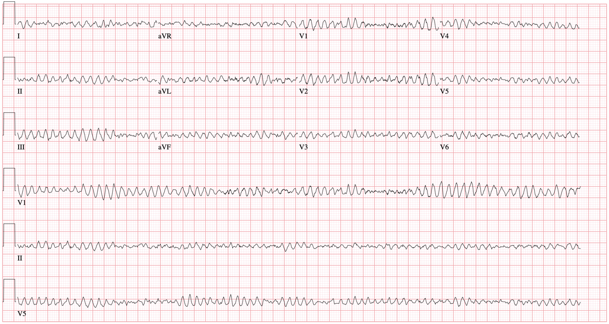 Differential Diagnosis of LVAD