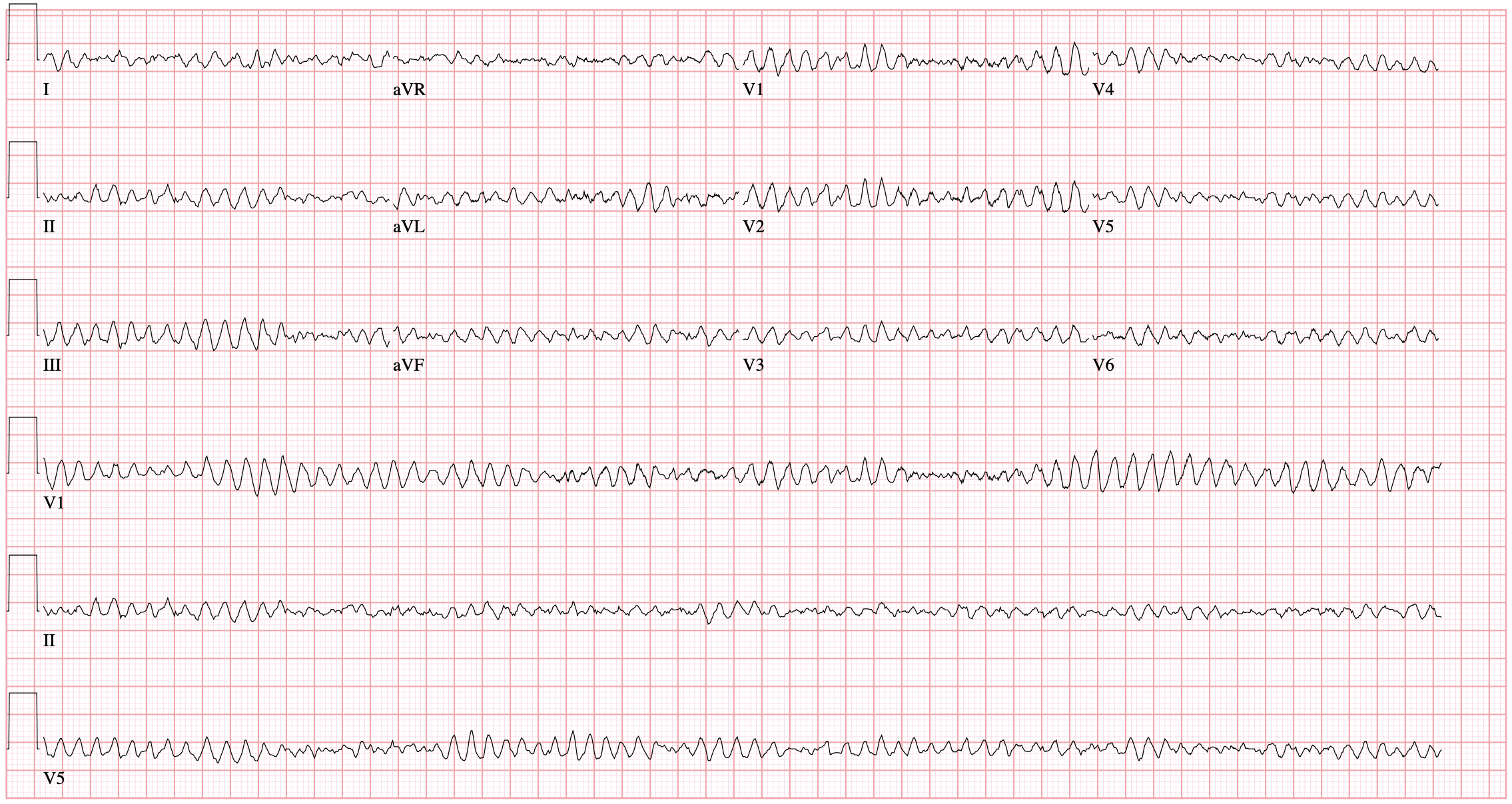 ventricular fibrillation vs atrial fibrillation