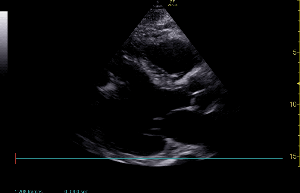 Ultrasound showing parasternal long axis view of fibrillating heart
