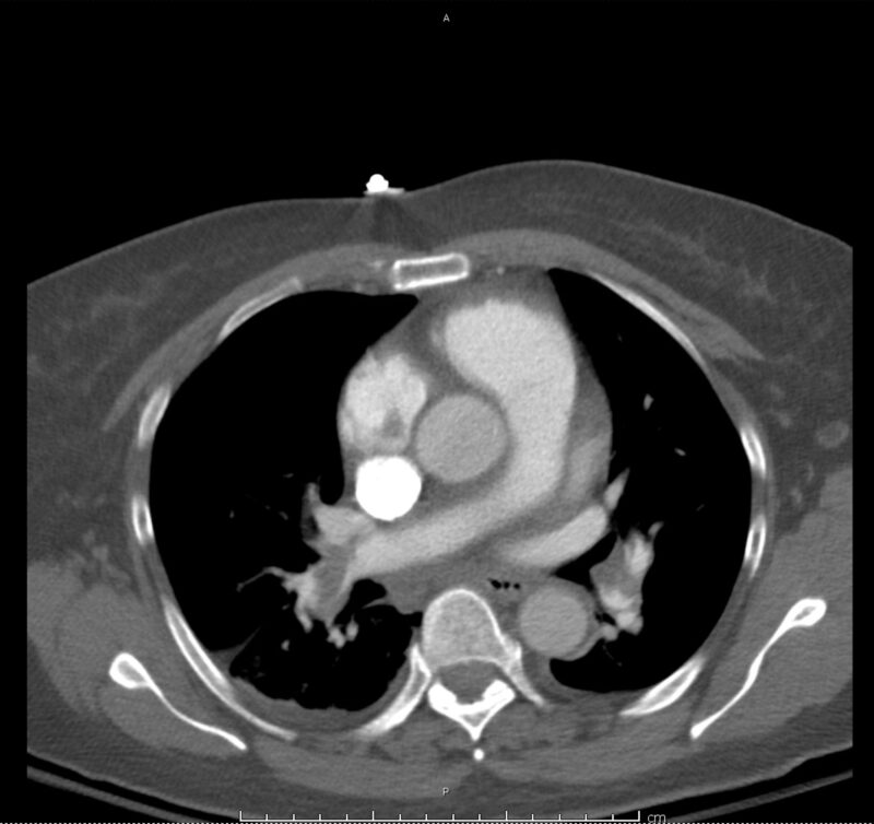 08_pe-saddle - Differential Diagnosis of