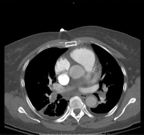 09_pe-saddle - Differential Diagnosis of