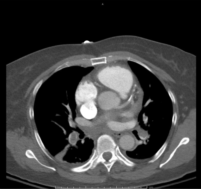 10_pe-saddle - Differential Diagnosis of