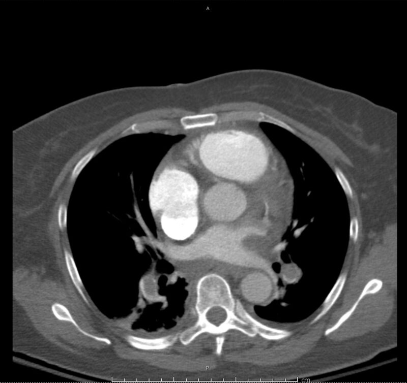 12_pe-saddle - Differential Diagnosis of