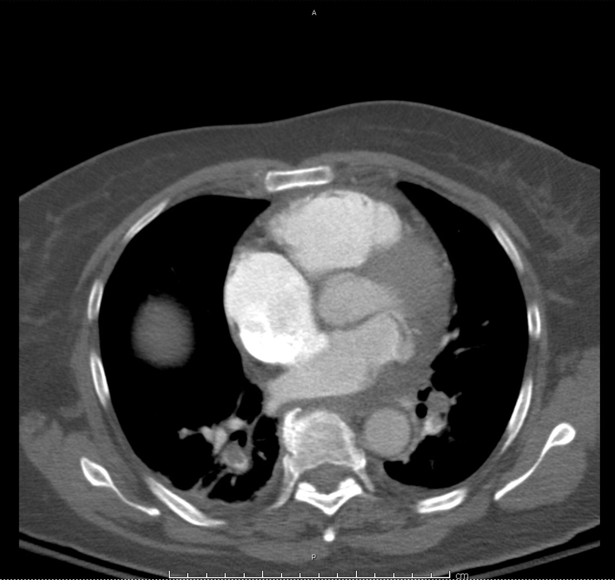 14_pe-saddle - Differential Diagnosis of