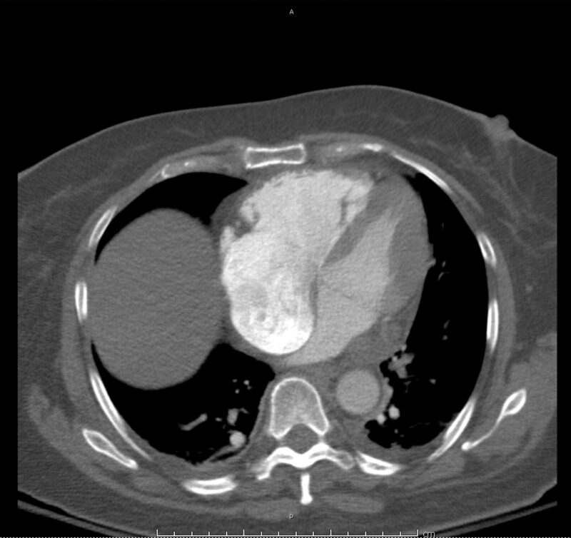 17_pe-saddle - Differential Diagnosis of