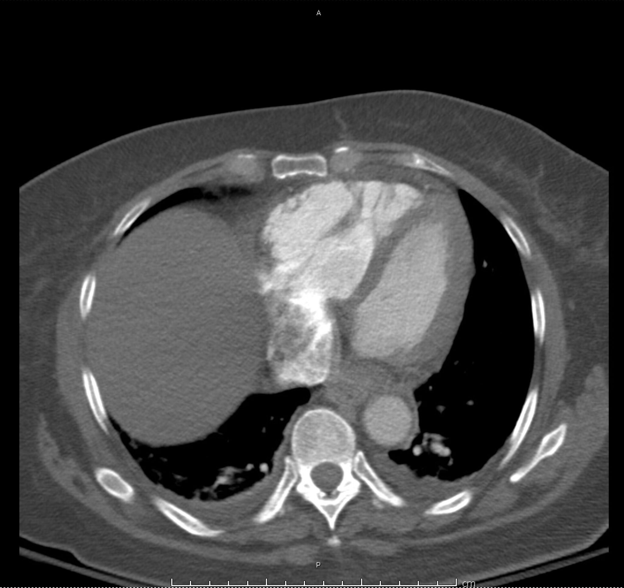 19_pe-saddle - Differential Diagnosis of