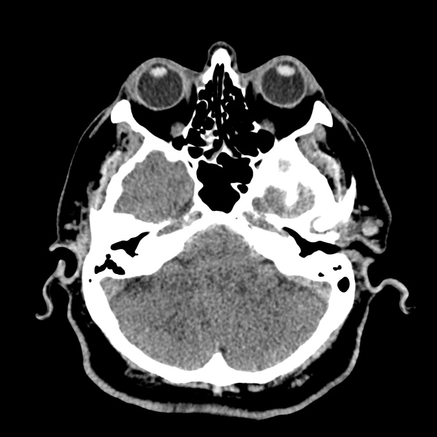 08_subdural