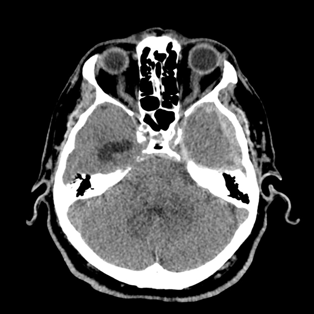 Differential Diagnosis of Anticoagulant Reversal in Intracranial Hemorrhage