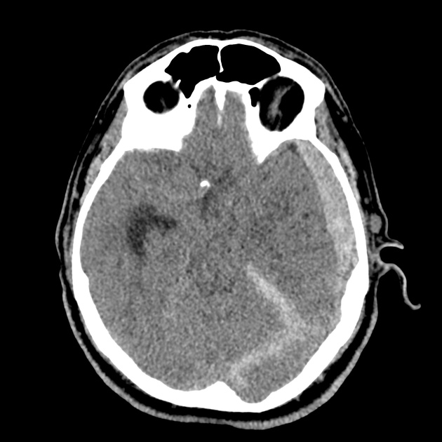 16_subdural