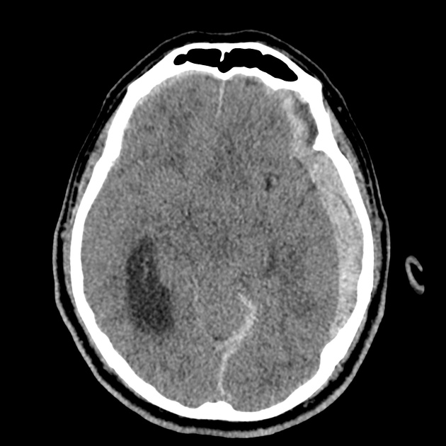 20_subdural