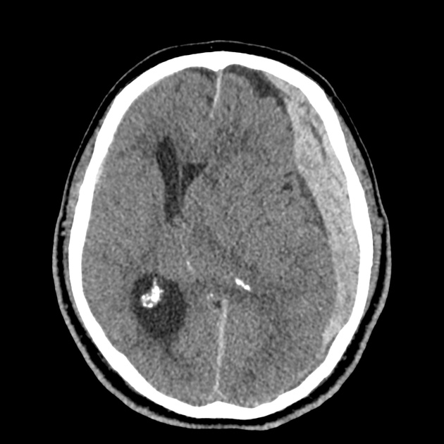 26_subdural