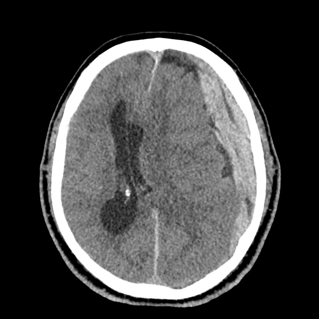 30_subdural