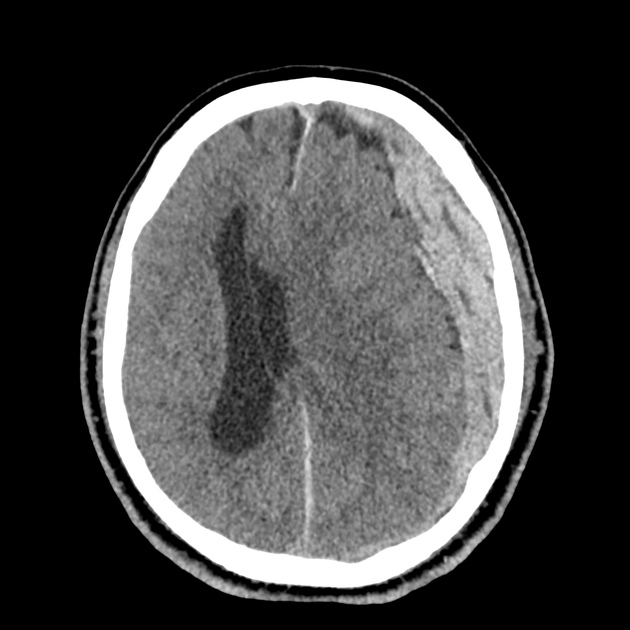 32_subdural