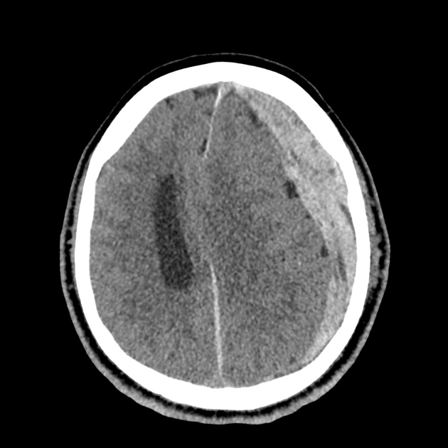 36_subdural