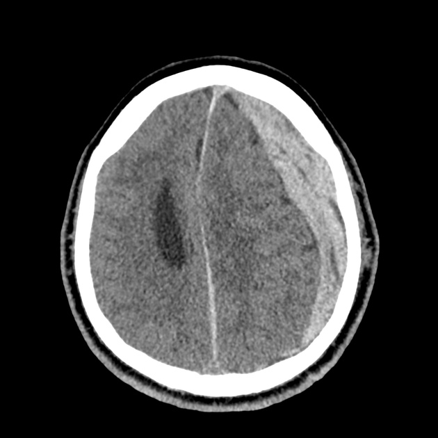 38_subdural