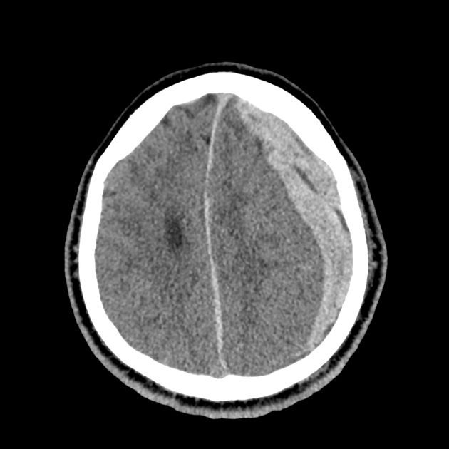 40_subdural