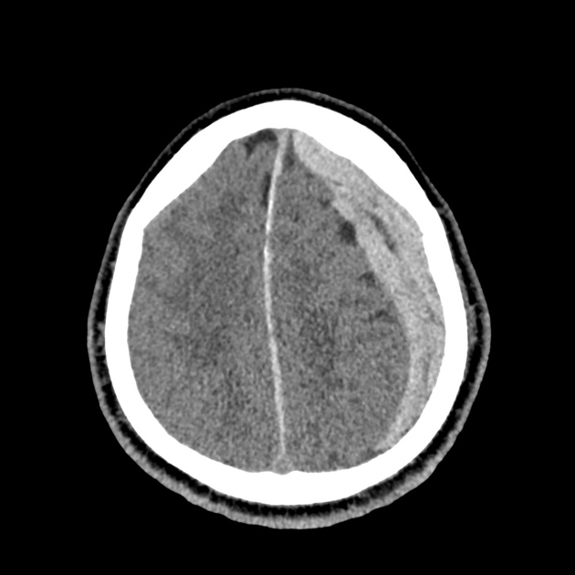 42_subdural