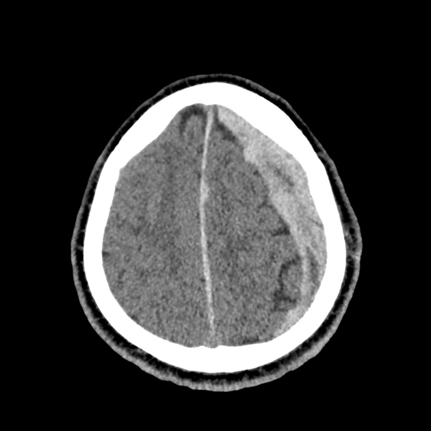 44_subdural