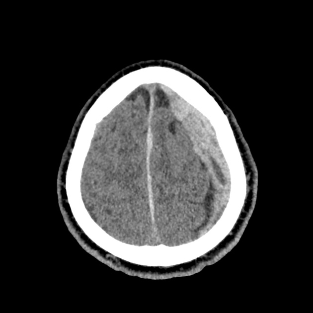 46_subdural