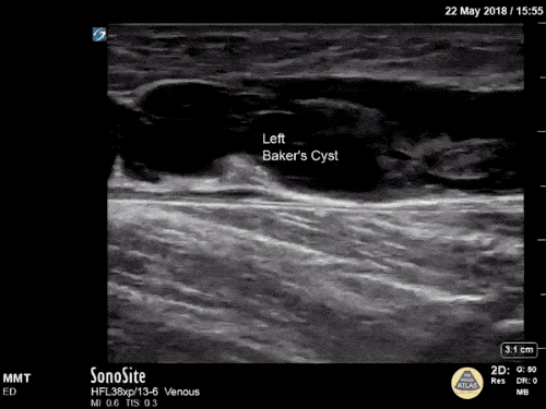 Longitudinal view of a ruptured Baker cyst