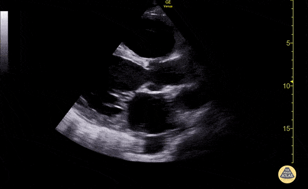 Ultrasound image of heart with depressed ejection fraction